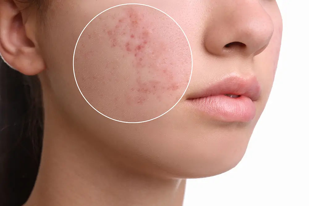 O motivo das acnes e oleosidade está onde você menos espera...