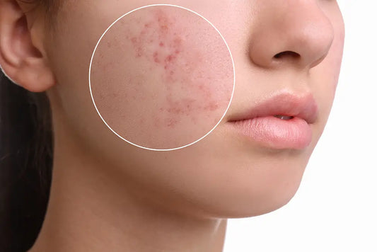 O motivo das acnes e oleosidade está onde você menos espera...